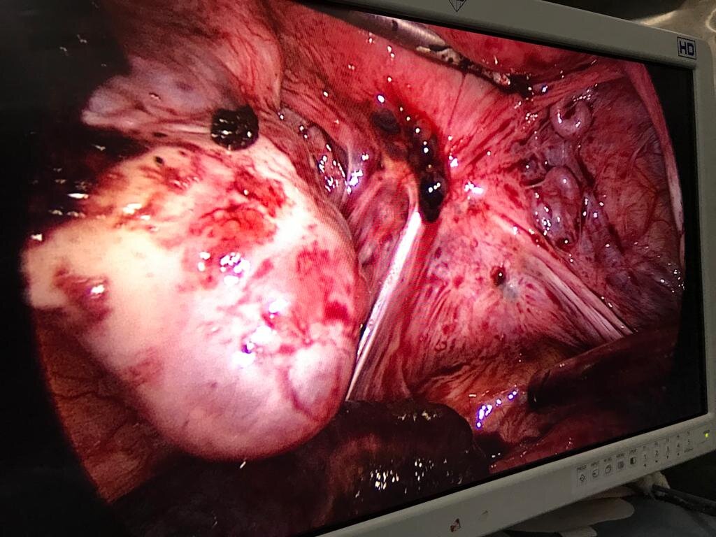 endometriosis_opt_1