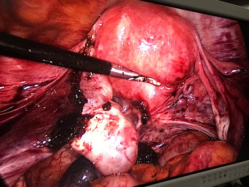endometriosis_opt_2